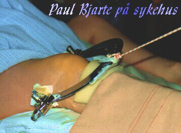 Paul Bjarte p� sykehus